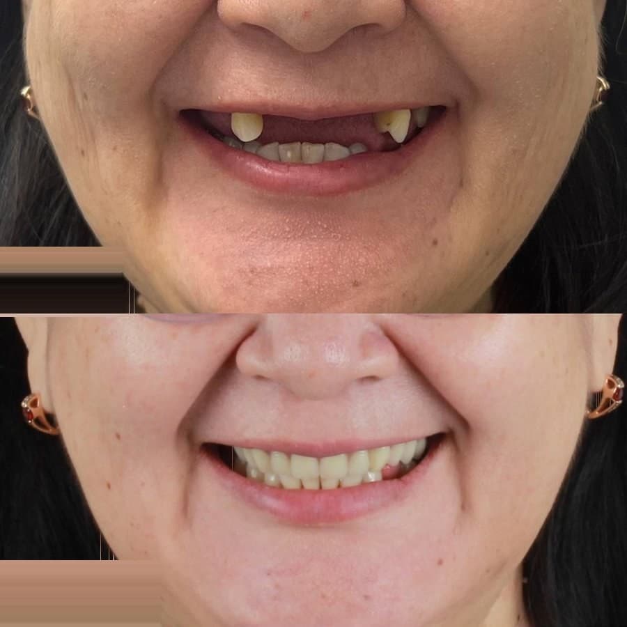 Full smile restoration: before and after at Dentor