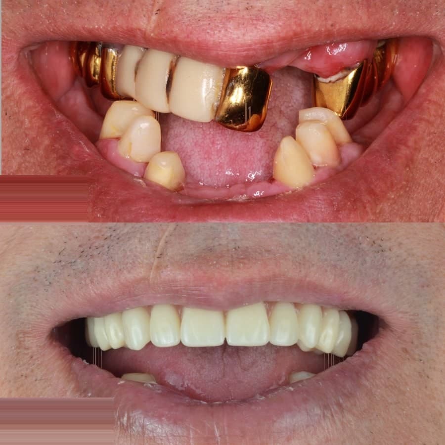 Crowns & prosthetics: before and after at Dentor