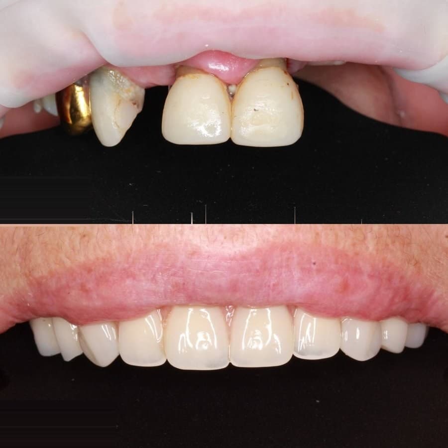 Smile makeover: before and after at Dentor